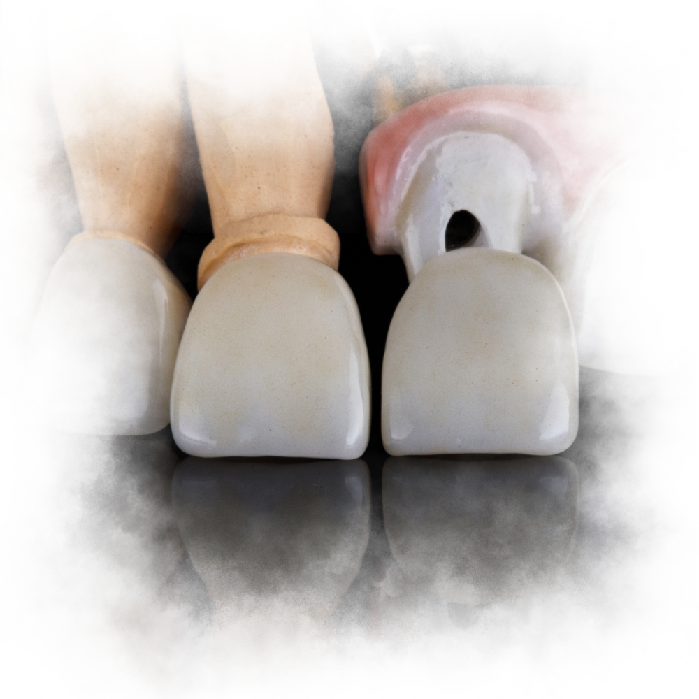 dental crown porselen