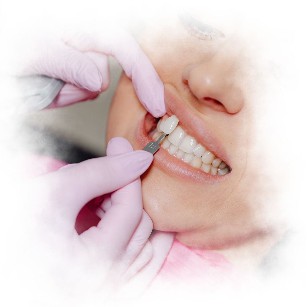 veneer gigi kelas a