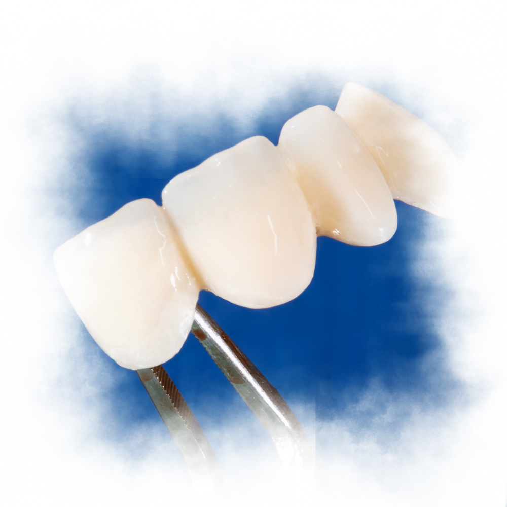dental crown pfm